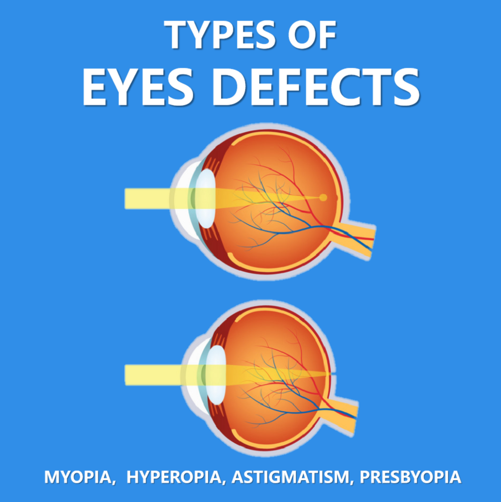 Types of Eyes Defects